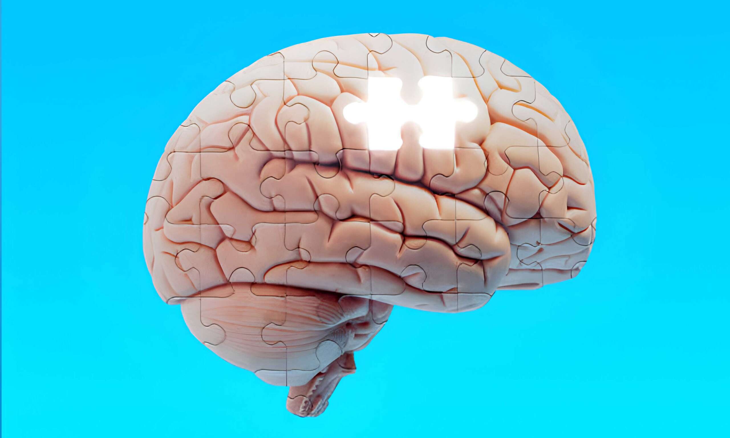 Demans – Alzheimer Hastalığı
