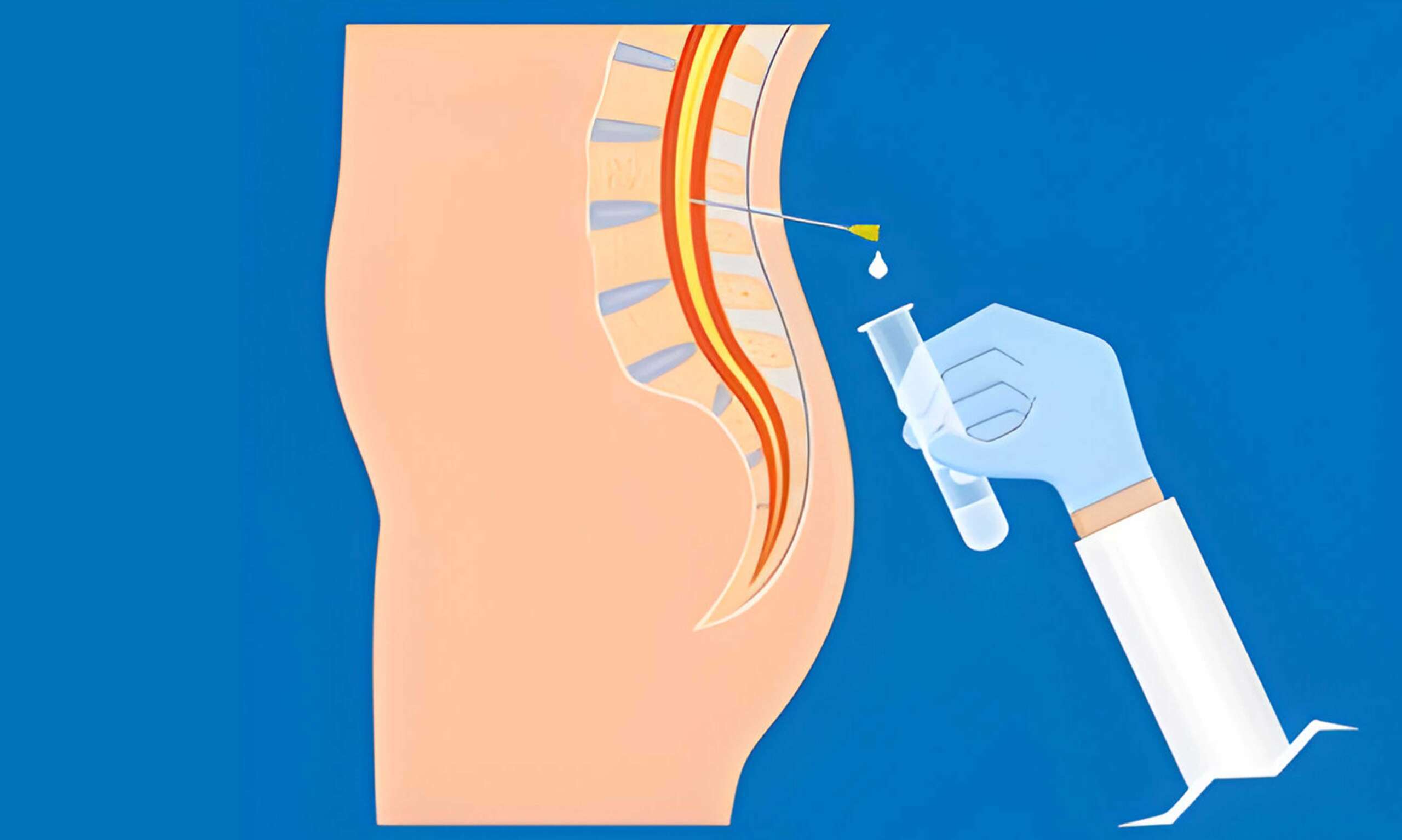 Lumbar Ponksiyon
